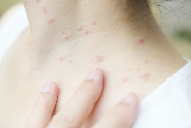 アレルギー性接触皮膚炎